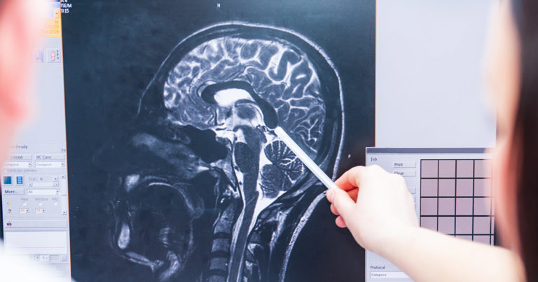 Traumatic Brain Injuries and Life Care Plans: What You Need To Know